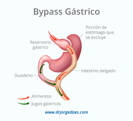 Bypass gastrico en Barranquilla Colombia